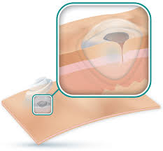 Image result for Hydrogel Dressing