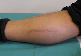 Gastrocnemius Muscle Herniation As A Rare Differential Diagnosis Of Ankle Sprain Case Report And Review Of The Literature Patient Safety In Surgery Full Text