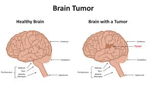 Tumors of the central nervous system in children are characterized by the heterogeneity of the cellular composition. 5 Types Of Paediatric Cancers Warning Signs And Symptoms Details Medanta