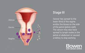 Low back pain or pelvic pain can be linked to problems with reproductive organs, such as the cervix. What Is Cervical Cancer Cervical Cancer Explained Bowen Icon Cancer Centre