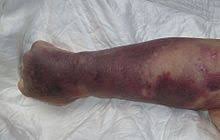 Find out more about blood platelets. Thrombocytopenia Wikipedia