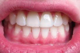 Say Braces Before And After Braces Braces Off Underbite Fixed Perfect Teeth Teeth After Braces After Braces