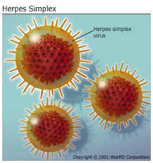 Image result for herpes 1 lip sore