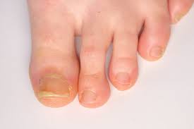 Image result for Yellow nail syndrome feet