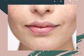 Ingrown hairs can be very uncomfortable and painful, especially if on the scrotum. Upper Lip Hair Removal How To Wax Your Upper Lip At Home Hellogiggles
