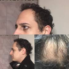 Maybe you would like to learn more about one of these? Should I Go Bald Bald