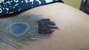 We did not find results for: 6 Possible Laser Tattoo Removal Side Effects And How To Deal With Them Tattoo Removal Institute