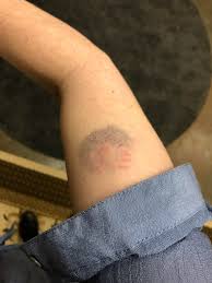 Image result for Human Bite