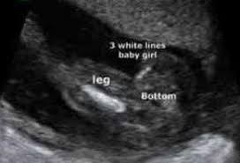 Gender Scans Sexing Your Baby The Original Window To The Womb