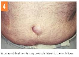Image result for Umbilicus botryoides