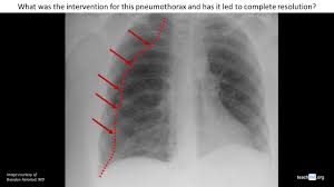 Image result for Pneumothorax