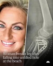 Sally Dixon's beach vacation turned into a lingering health nightmare after  she fell into a knee-deep hole someone dug in the sand and didn't fill when  they left. She broke her leg,