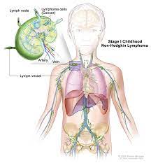 Thomas hodgkin who, in 1832, described several cases of people with symptoms of cancer involving the lymph nodes. Figure Stage I Childhood Non Hodgkin Lymphoma Pdq Cancer Information Summaries Ncbi Bookshelf