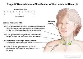 You should look for the following symptoms of nasal cavity and paranasal sinuses cancer inflammation around the jawbone. Definition Of Stage Iv Nonmelanoma Skin Cancer On The Head And Neck Not On The Eyelid Nci Dictionary Of Cancer Terms National Cancer Institute
