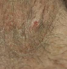 Both herpes and ingrown hairs can cause painful red blisters, itching, and skin irritation. Is This An Ingrown Hair Or Something More Serious Ask A Doctor Free Best Answers Reviews Recommendations