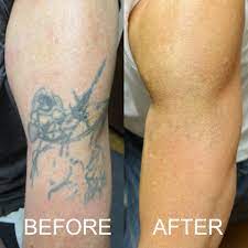 Pin On Top 100 List Tattoos Removal
