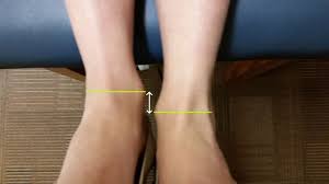 Image result for Functional Leg Length Discrepancy
