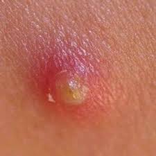 Myiasis is defined as the infestation of live vertebrates (humans and/or animals) with dipterous larvae. Furuncular Myiasis Litfl