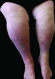 I believe it was growing pains. Thick Legs Not Always Lipedema Reich Schupke 2013 Jddg Journal Der Deutschen Dermatologischen Gesellschaft Wiley Online Library