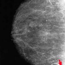 He ordered a mammogram to put my mind at ease. Mammogram Images Normal And Abnormal