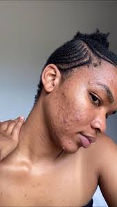 Cuticura Bar Soap Good for Acne