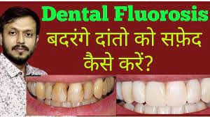 Dental Fluorosis Treatment With Cost Youtube