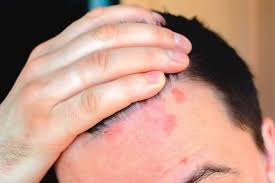 Buna ziua ma puteti ajuta cu o crema?fetitei mele de 4 luni ia iesit pe frunte pete rosi cu bubite mici aspre si pe corp doar pete rosi care apar si dispar! Psoriazis Poze Psoriazis Imagini Divahair Ro