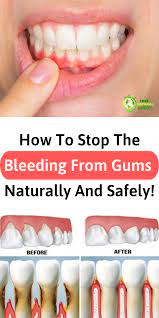 Next, use a clotting powder (styptic is best) to stop the bleeding. How To Stop Teeth Bleeding In Tamil Arxiusarquitectura