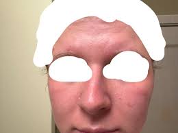 this is super vulnerable for me so please be kind. i've had acne for as  long as i can remember. (im 22, no children, no birth control, using  adapelene 0.1% for over