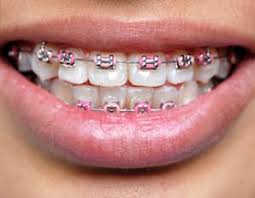 Konsultasi gigi palsu 100% gratis. Berapa Kos Rawatan Pendakap Gigi Braces