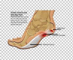 Heel Pain Calcaneal Spur Plantar Fasciitis Foot PNG, Clipart, Free PNG Download