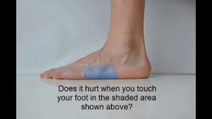 5th Metatarsal Examination Stress Fracture Metatarsal Fracture Tendinitis
