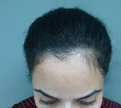 Are you looking for black hairstyles for long hair? Hair Transplantation In Dubai For Black Women Hair Transplant Dubai