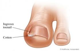 Non Aux Ongles Incarnes