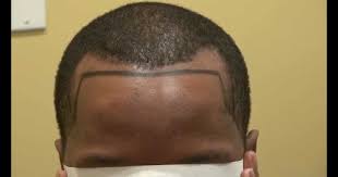 Black hair is the darkest and most common of all human hair colors globally, due to larger populations with this dominant trait. Receding Hairline Treatment For Black Men