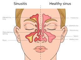 Image result for Maxillary Sinus