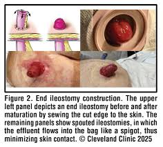 Image result for Enterostomy