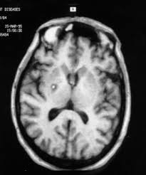 Image result for Pallidotomy