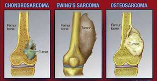 It can spread to distant organs, such as the lungs. Bone Cancer Surgery In India Cost Treatment Surgery Top Hospital Best Doctors In India 2021