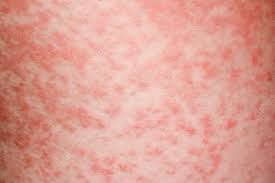 The most common presentation of infectious mononucleosis is with a fever, enlarged lymph nodes and a sore throat. Amoxicillin Rash In Glandular Fever Stock Image C034 5320 Science Photo Library