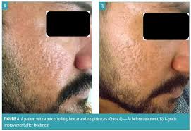 Menghilangkan bopeng dg treatment subsisi.for sharing tinggalkan komentar di bawah ya. Subcision And Microneedling As An Inexpensive And Safe Combination To Treat Atrophic Acne Scars In Dark Skin A Prospective Study Of 45 Patients At A Tertiary Care Center Jcad The