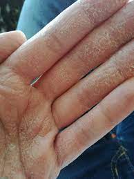 Haut Schalt Sich Schlimm An Den Handinnenflachen Gesundheit Und Medizin Hand Hautarzt