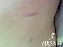 I have had a gastric sleeve. Gastric Sleeve Scars Guide To Reduce Scarring Quickly