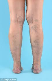 The 6 Surprising Places Varicose Veins Can Appear Other Than Your Legs Daily Mail Online