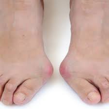 Jenis jari ini ditandai dengan jempol kaki yang lebih panjang dengan jari lain secara bertahap memiliki ukuran yang lebih pendek. Inilah Cara Menghilangkan Bunion Tanpa Operasi