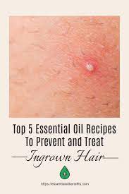 Ingrown hair1 is an opposite phenomenon of healthy hair growth. Pinterest Osterreich