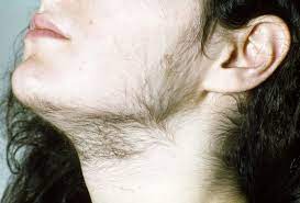 In fact, one study found that almost 40% of women age 45 and older have an excess of facial hair growth, especially on the chin. Hairiness Skin Disorders Merck Manuals Consumer Version