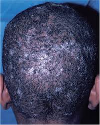 There is hair loss with visible scalp disease and there is hair loss without scalp disease. Hair Loss Common Causes And Treatment American Family Physician
