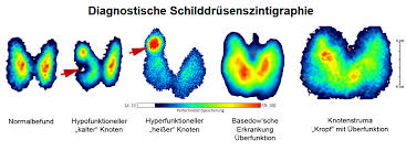 Die schilddrüse ist ein kleines, hormonaktives organ. Schilddrusenambulanz Universitatsklinikum Freiburg