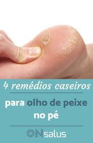Calos Nos Pés Olho De Peixe Olho De Peixe No Pe Causas E Tratamento Caseiro Em 2020 Olho De Peixe Tratamento Remedio Para Fungos Unha Com Fungos